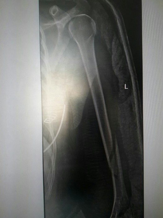 Перелом шейки плеча операция с пластиной thumbnail